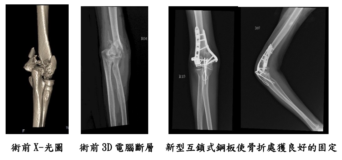 脆弱的手肘 : 遠端肱骨粉碎性骨折