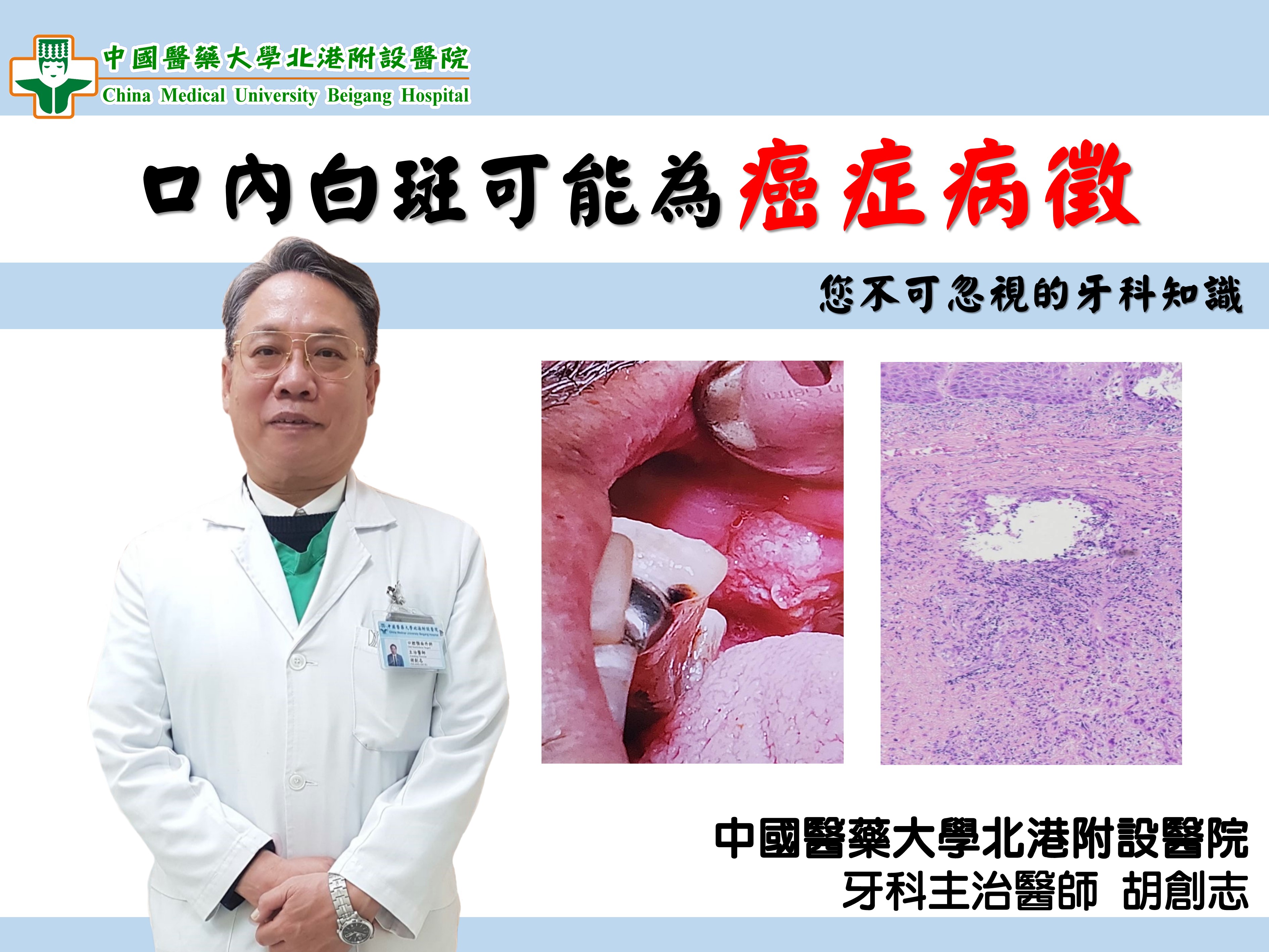 口內白斑可能為癌症病徵 您不可忽視的牙科知識