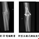 脆弱的手肘 : 遠端肱骨粉碎性骨折